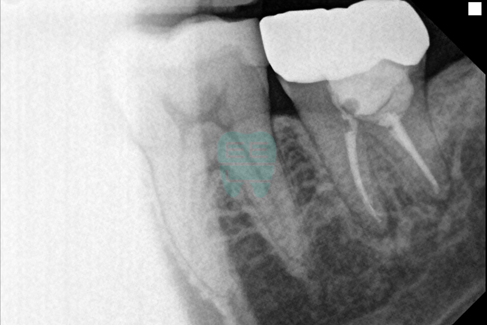 치료 전 엑스레이 - 하악 좌측 제2대구치 크라운 하방 상태 확인