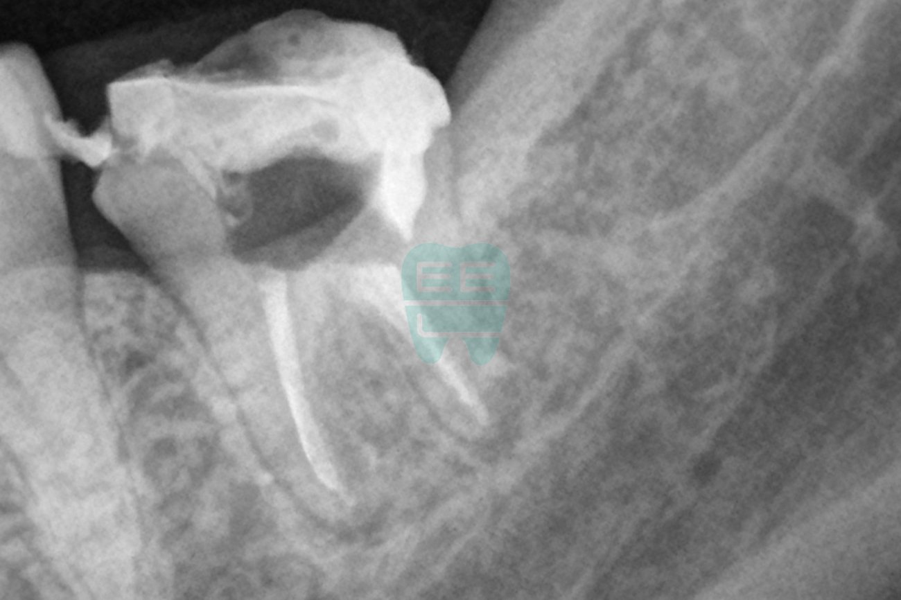 치료 후 엑스레이 - 재근관치료 및 레진코어 완료 상태 확인