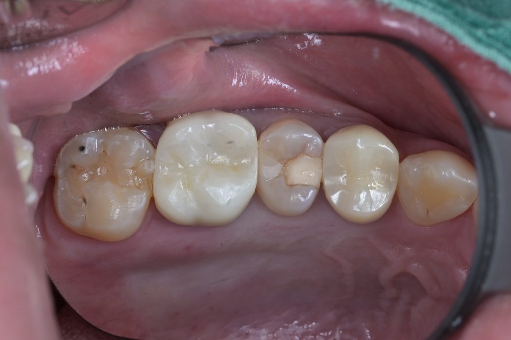 초진 시 #25 상악 제2소구치의 교합면 및 협측면에 깊은 우식 병소가 관찰되는 모습. 기존 수복물 하방으로 2차 우식이 진행된 상태