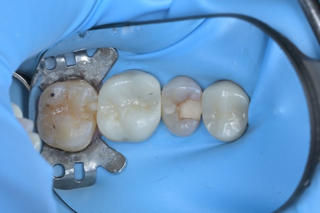 러버댐을 장착하여 치료 부위를 구강 내 타액과 세균으로부터 완전히 격리한 모습. 무균적 술식을 위한 필수 과정
