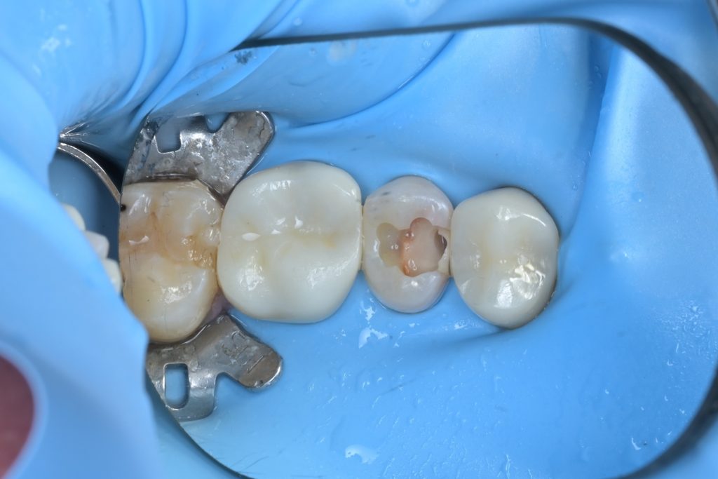 기존 아말감 또는 레진 수복물과 그 하방의 연화된 우식 상아질을 미세현미경 하에서 제거하는 과정