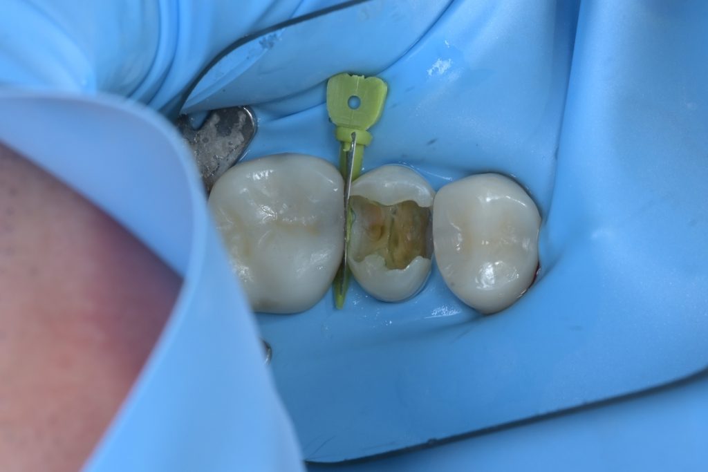 우식검사액으로 염색된 부위를 추가로 제거하는 과정. 치수에 가까운 깊은 부위까지 세심하게 접근하는 모습