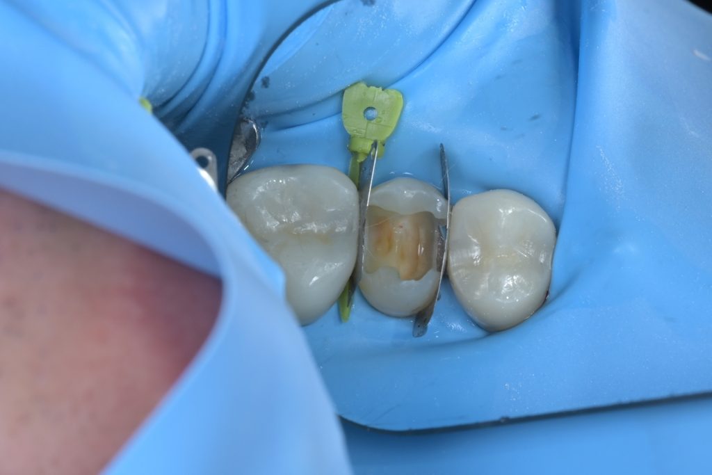 우식 제거 중 치수가 노출된 모습. 노출 부위에서 신선한 출혈이 관찰되며, 이는 치수가 생활력을 유지하고 있다는 긍정적 신호