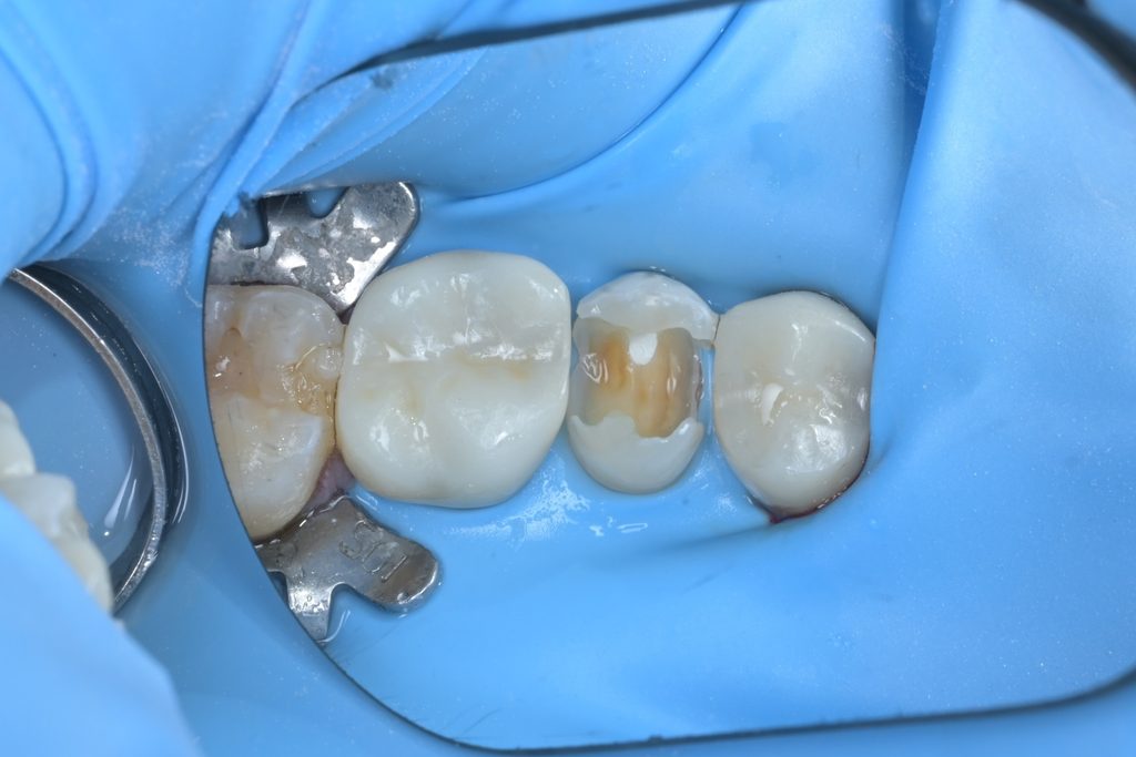 MTA 적용 후 전체적인 모습. MTA 상방으로 글래스아이오노머 라이너를 추가로 적용하여 2중 밀폐 효과를 구현