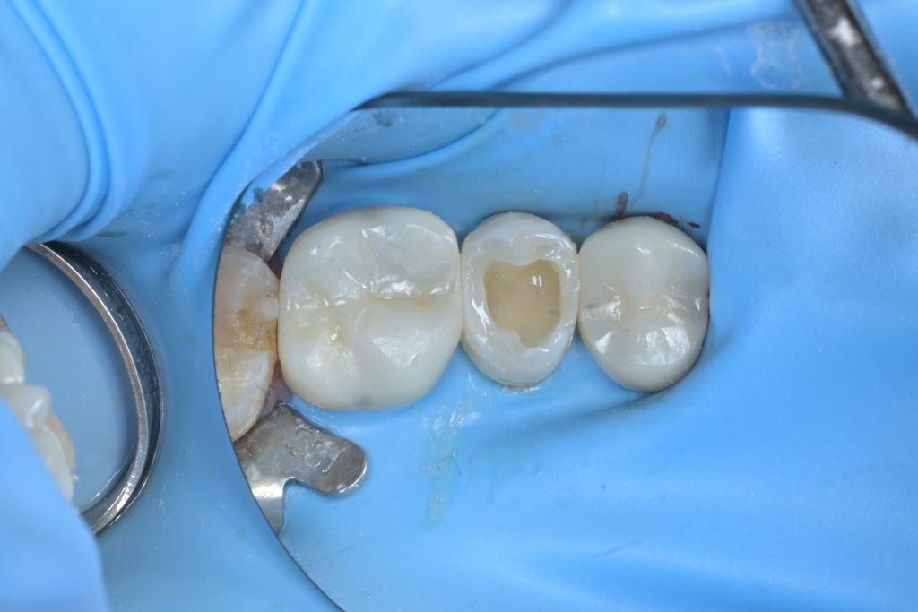 인접면 레진빌드업 과정. 매트릭스 밴드를 이용하여 인접치와의 접촉점을 정확하게 재현하는 모습