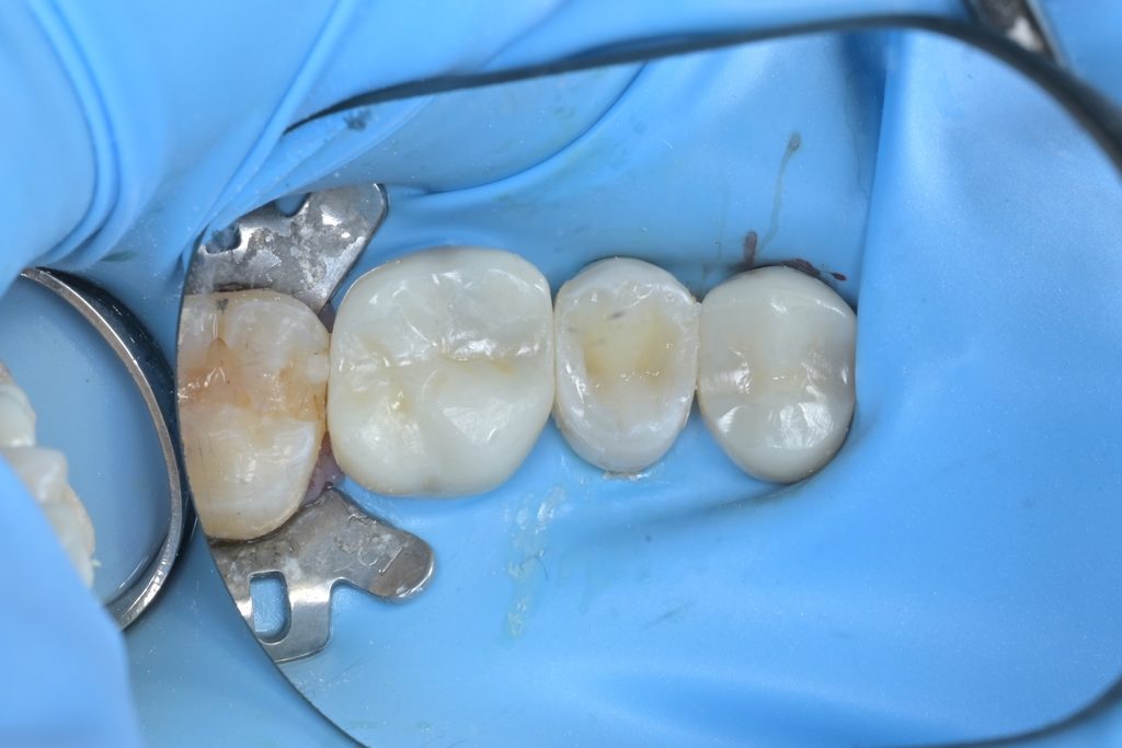 교합면 레진빌드업 과정. 복합레진을 층별로 적층 충전하며 소구치의 교두와 열구 형태를 재현