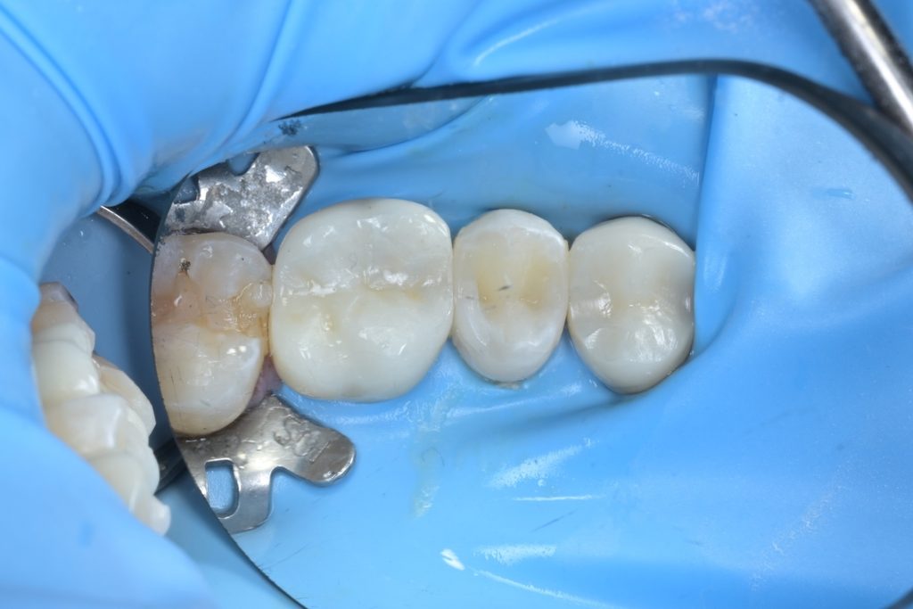레진빌드업 완료 직후 모습. 자연치와 유사한 색조와 형태가 재현됨