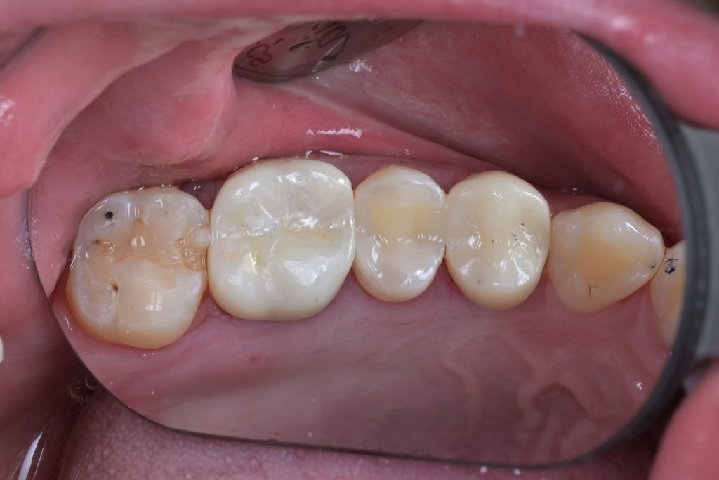 다각도에서 확인한 레진빌드업 완료 상태. MTA 생활치수치료 후 즉시 최종 수복까지 완료