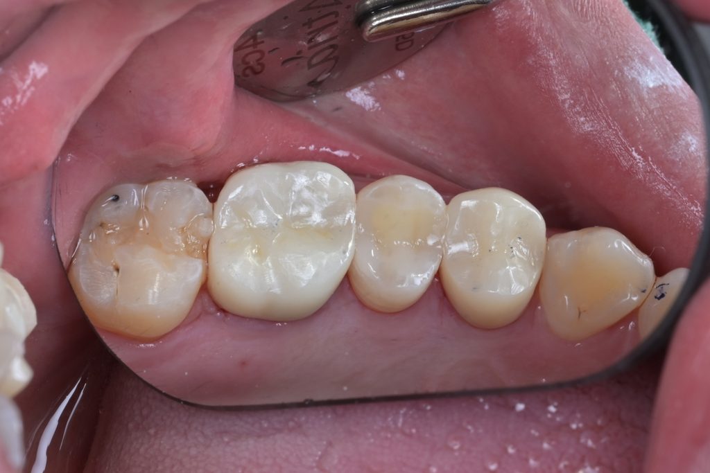 교합 조정 및 최종 연마를 완료한 #25 교합면. 자연스러운 광택과 해부학적 형태가 완성됨