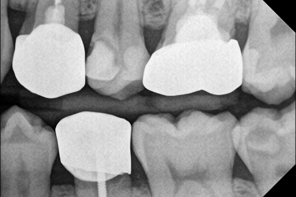치료 전 교익방사선 사진. #25 원심부에 방사선 투과상이 관찰되며, 치수강에 근접한 깊은 우식 병소가 의심됨