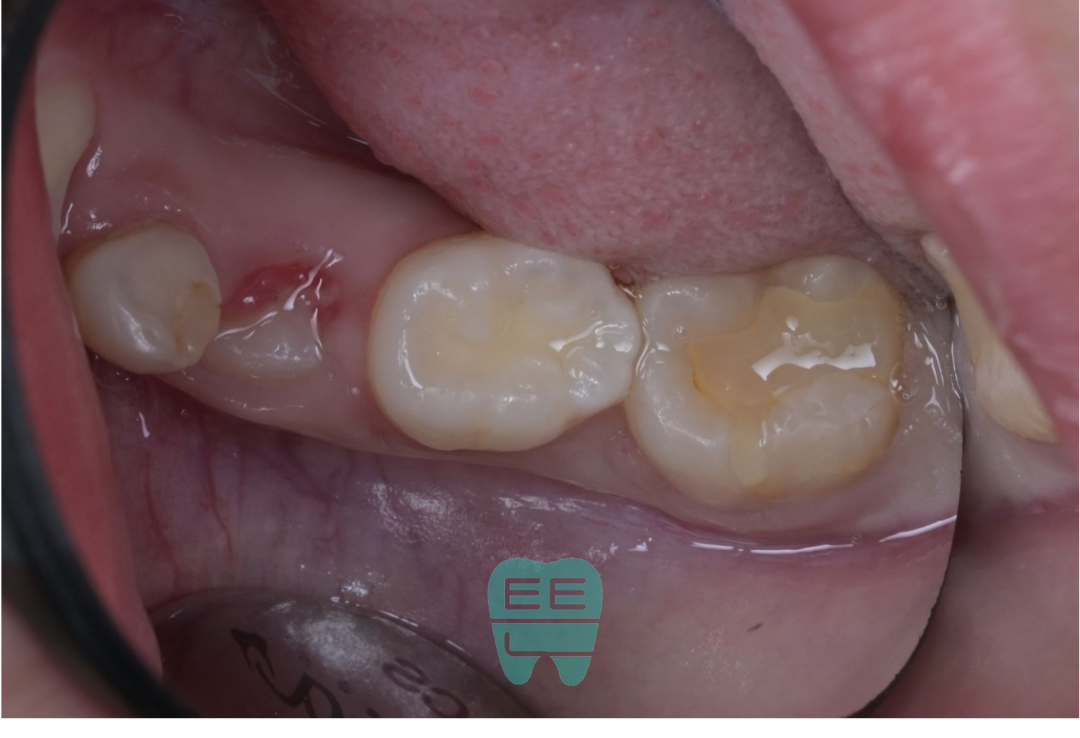 만 9세 환자 #46 초진 상태 - 기존 레진 치료가 되어있으나 들떠있는 모습