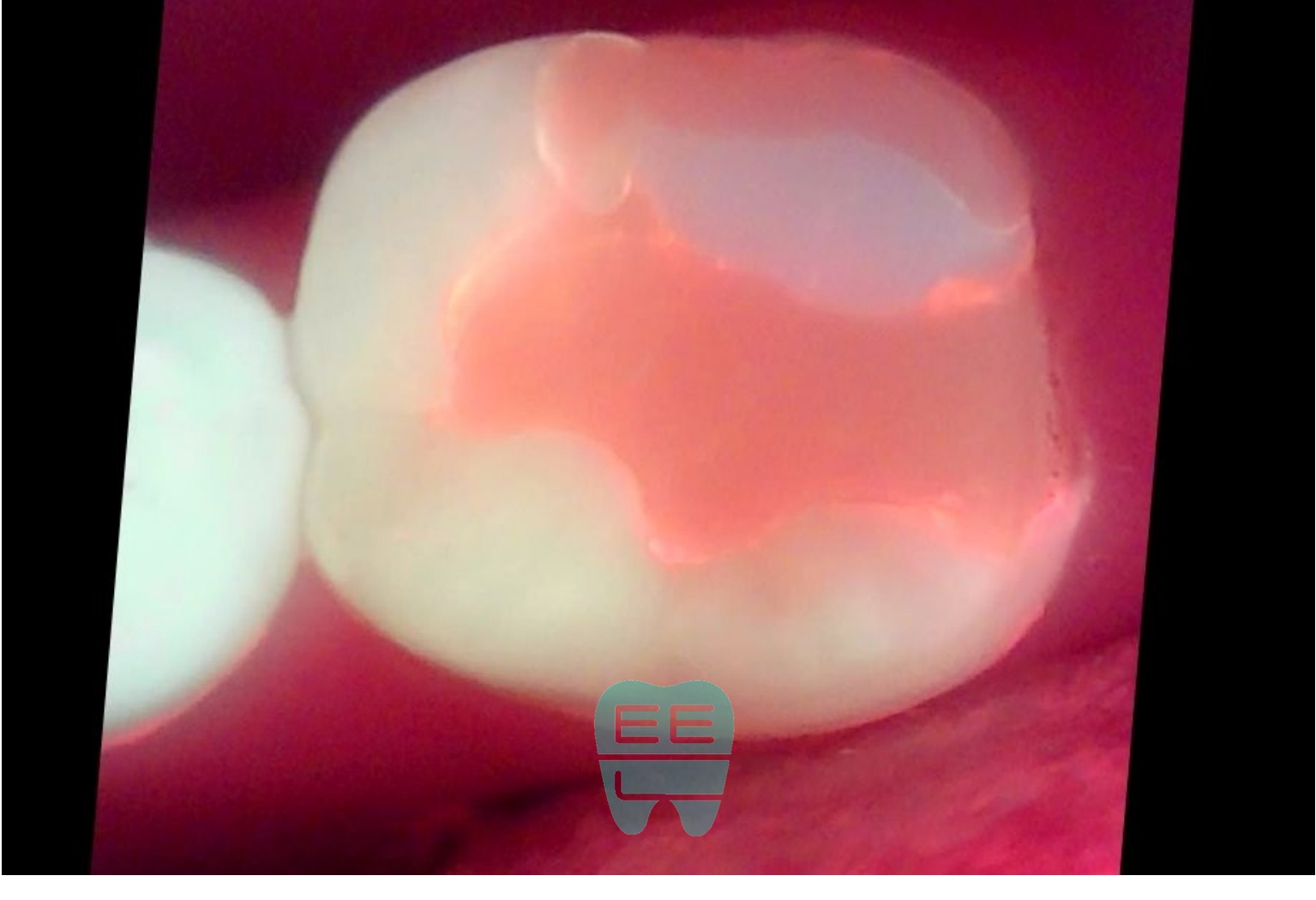 술전 Q-ray(QLF) 촬영 - 기존 레진 아래 광범위한 오염이 형광으로 관찰됨