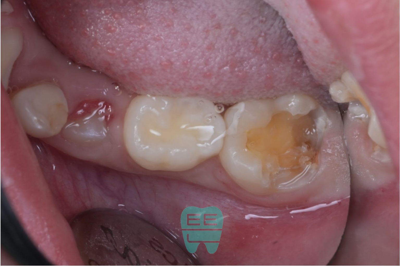 기존 레진 제거 중 - 접착이 안 되어 톡 탈락, 하방 2차우식과 치은연하 우식 관찰