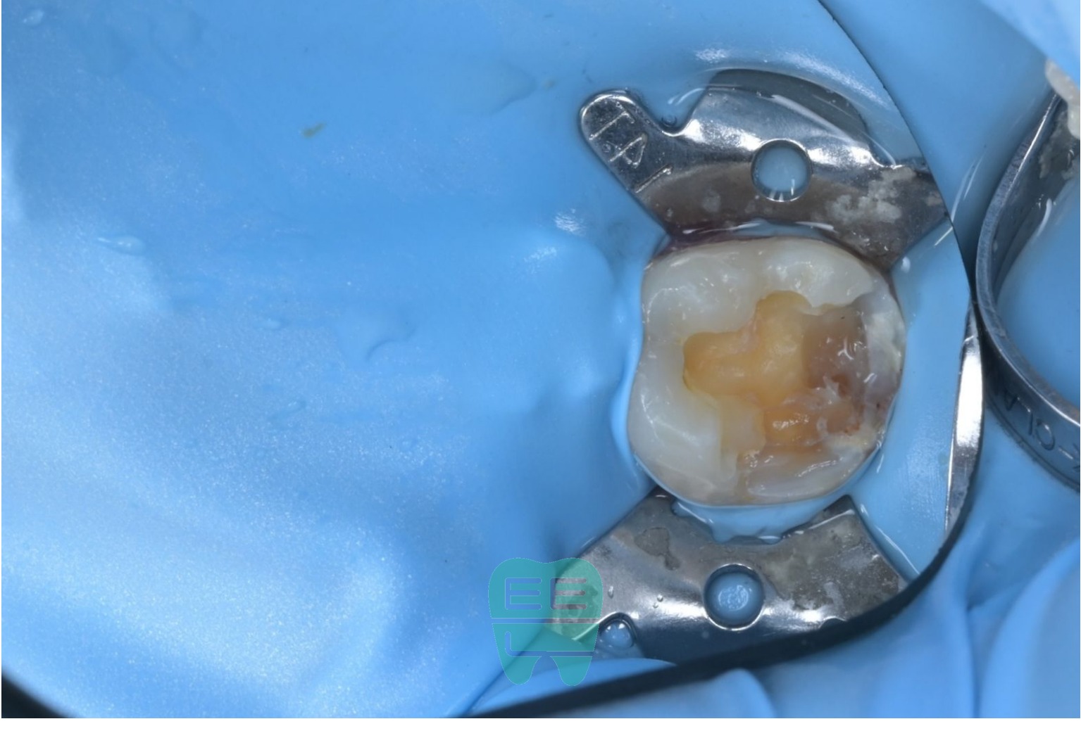 레이저로 잇몸을 다듬고 러버댐을 장착한 모습 - 완벽한 방습 환경 확보