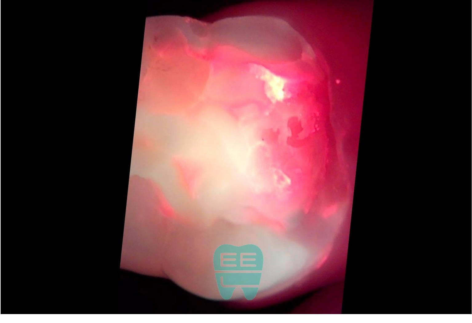 기존 수복물 제거 후 Q-ray 촬영 - 심한 오염이 관찰됨