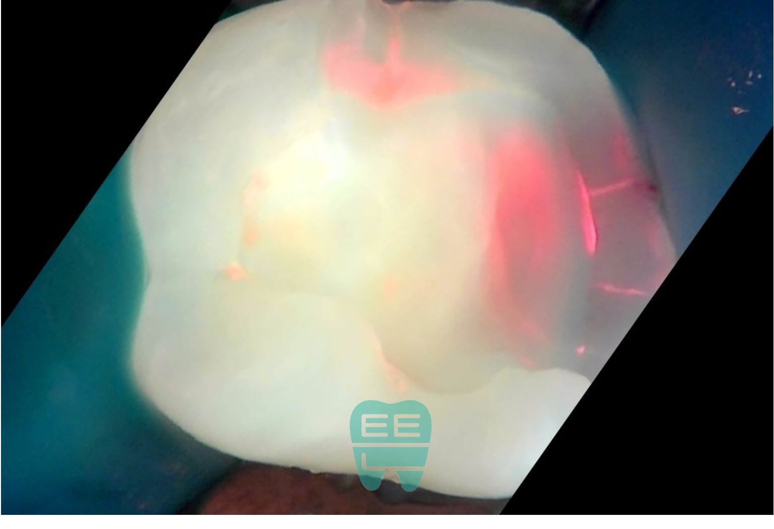 우식 제거 중 Q-ray 촬영 - 잔존 우식 및 오염 확인