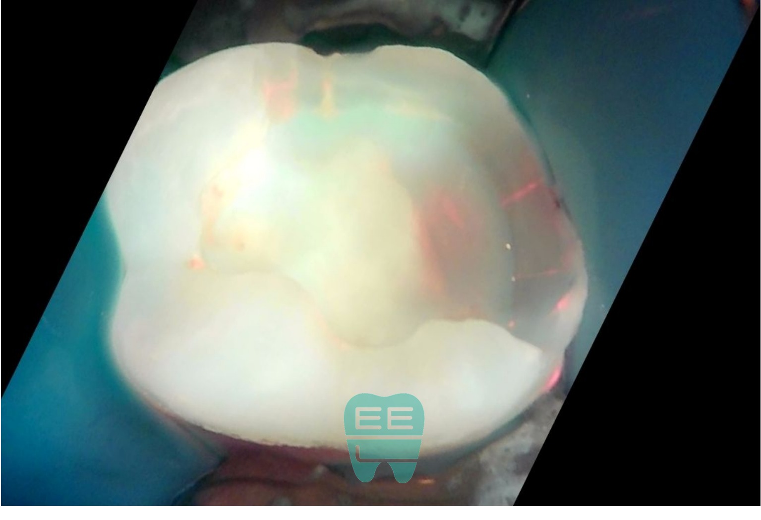 충치 제거 후 Q-ray 촬영 - 잔존 우식 및 오염이 상당히 제거된 상태