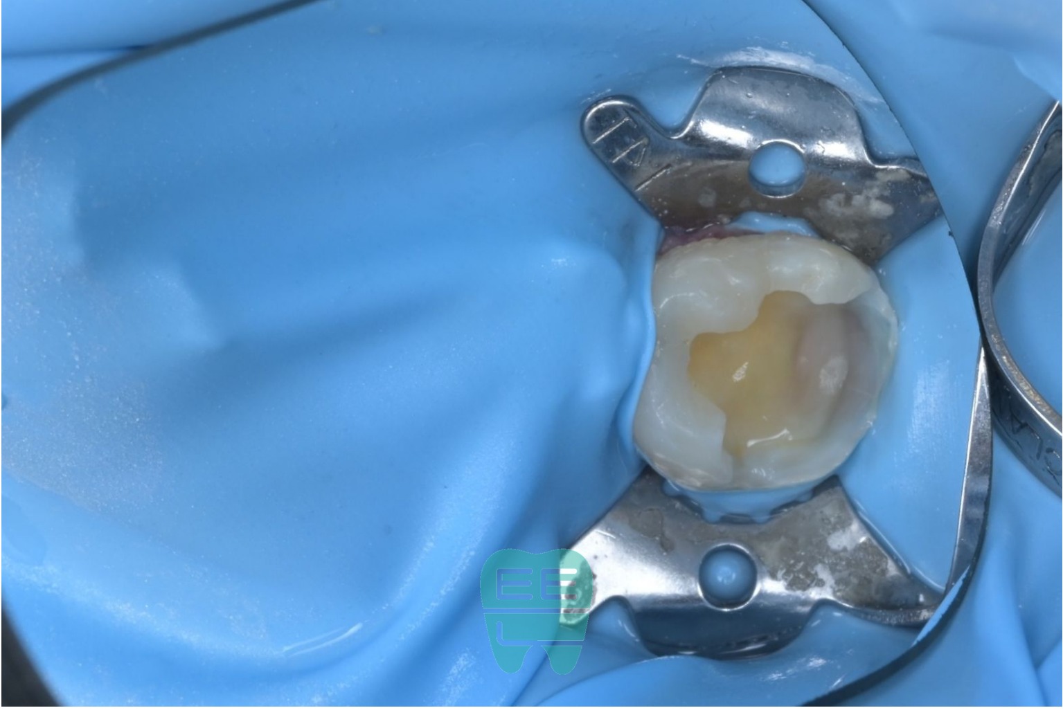 남은 충치를 제거하고 AquaCare로 치면 처리를 마친 상태