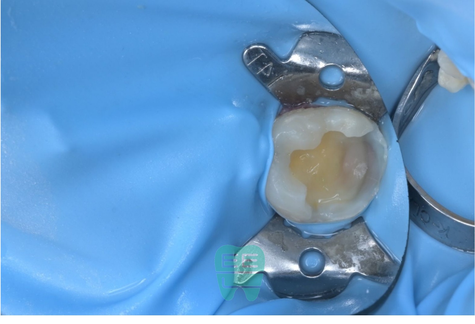 소아/청소년 충치치료는 최소침습 레진 빌드업이 정답 — 만 9세 #46 광범위 2차우식 치료 증례 - 레진빌드업 thumbnail