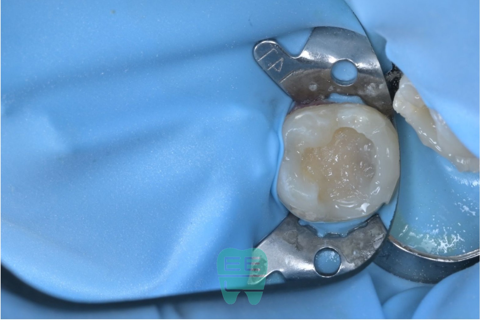 광범위한 충치 치료를 위한 fiber 보강 접착 과정