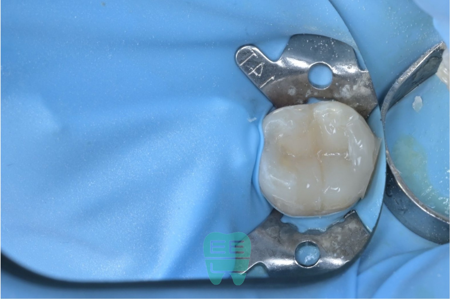 레진 빌드업이 완료된 상태 - 교합면 형태 재현