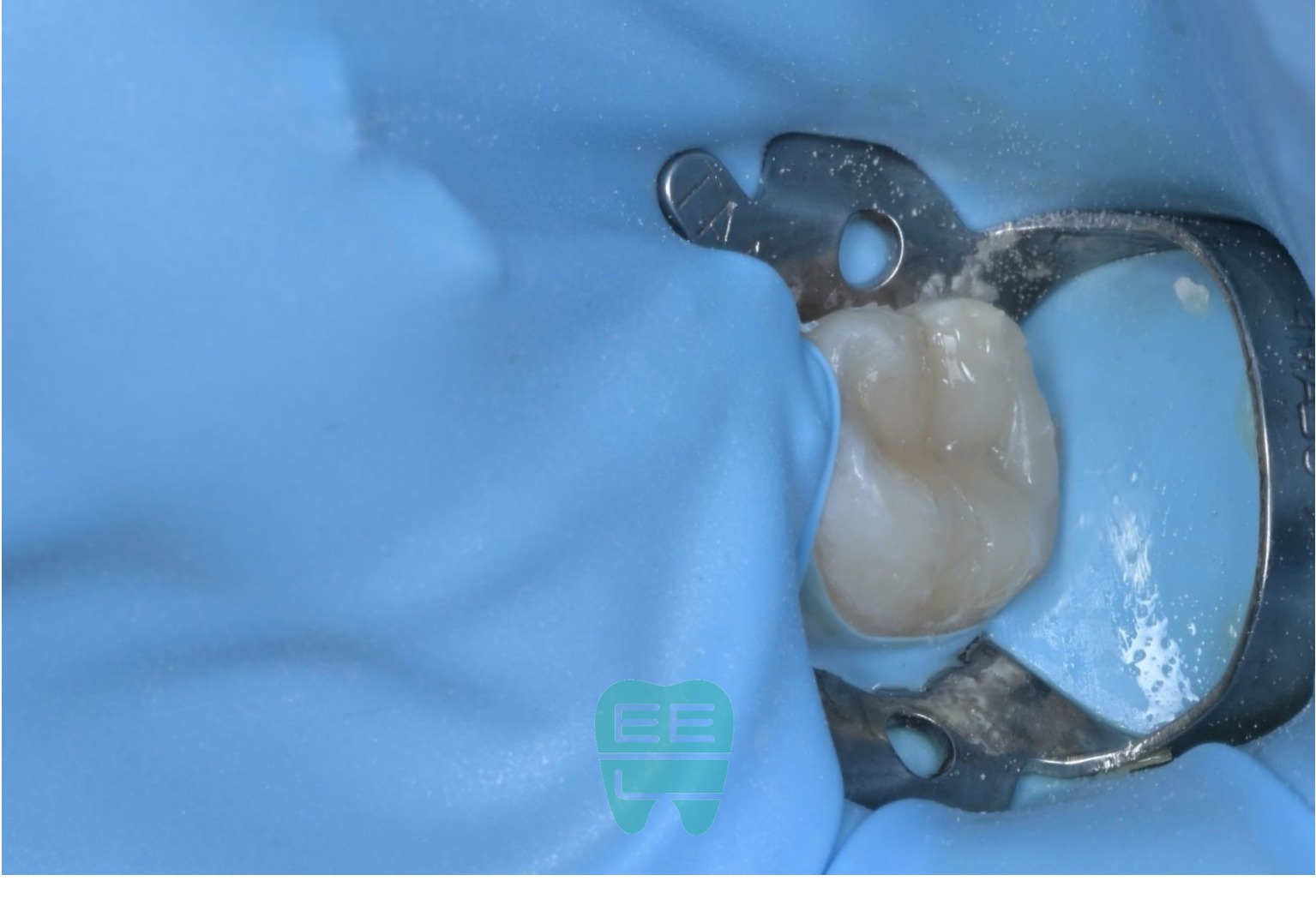 입체적으로 적절한 외형을 회복한 상태