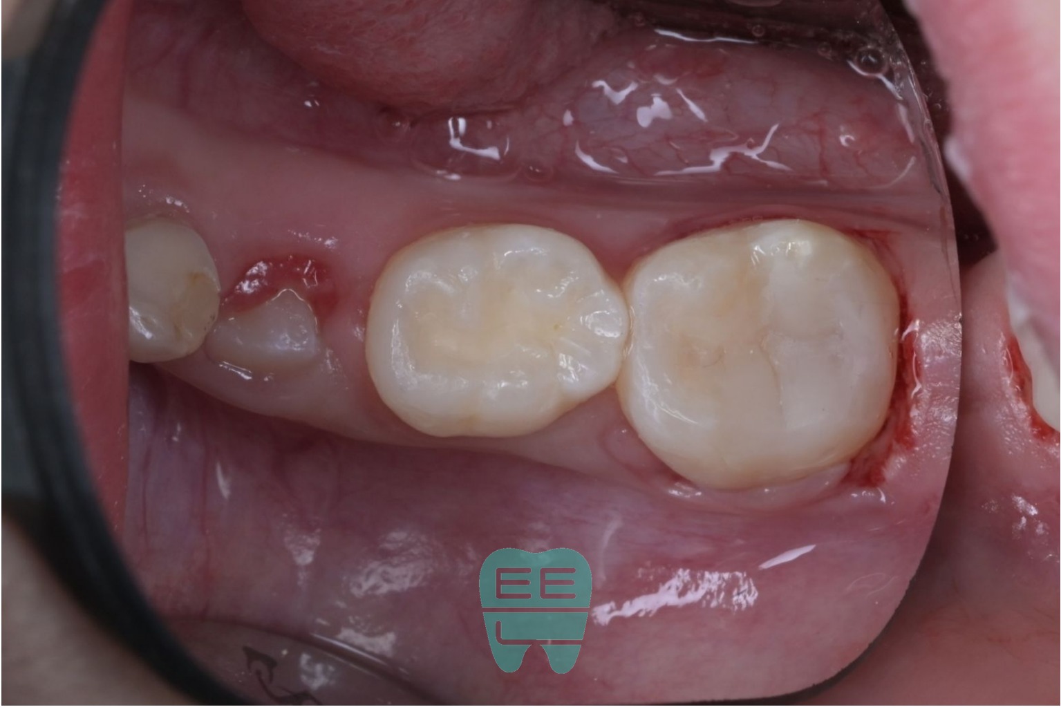 교합조정과 연마를 마친 최종 레진빌드업 상태