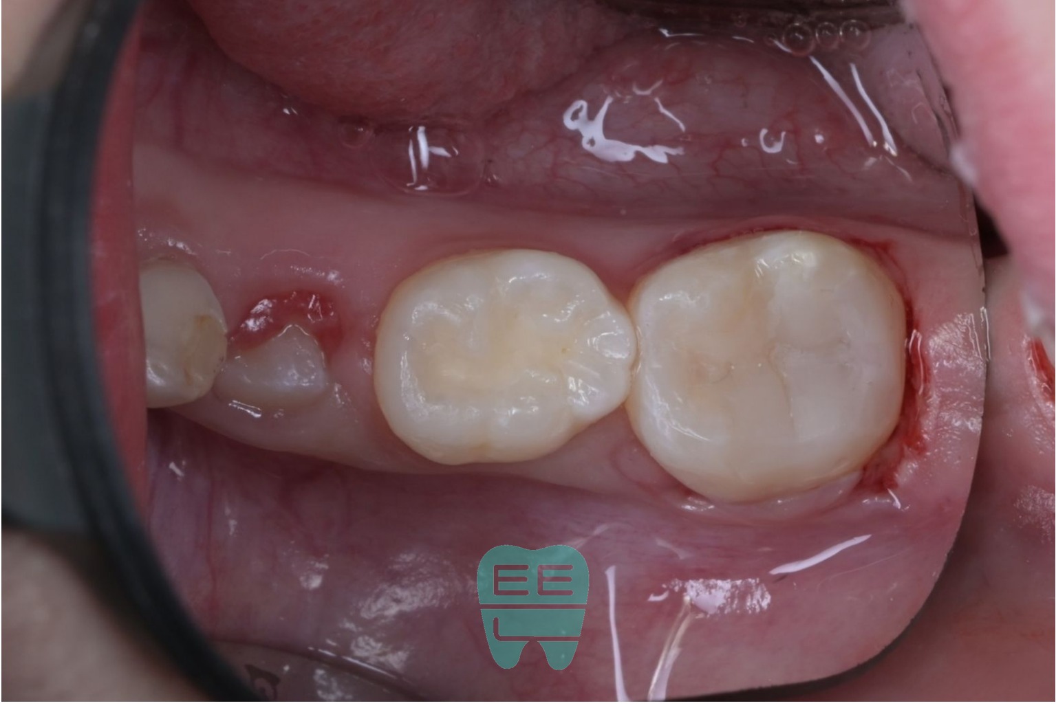 최종 레진빌드업 상태 - 다른 각도