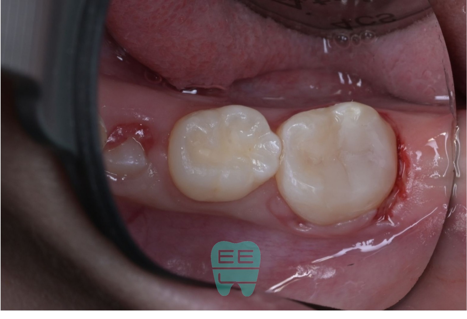 최종 레진빌드업 상태 - 주변 치아와 자연스러운 조화