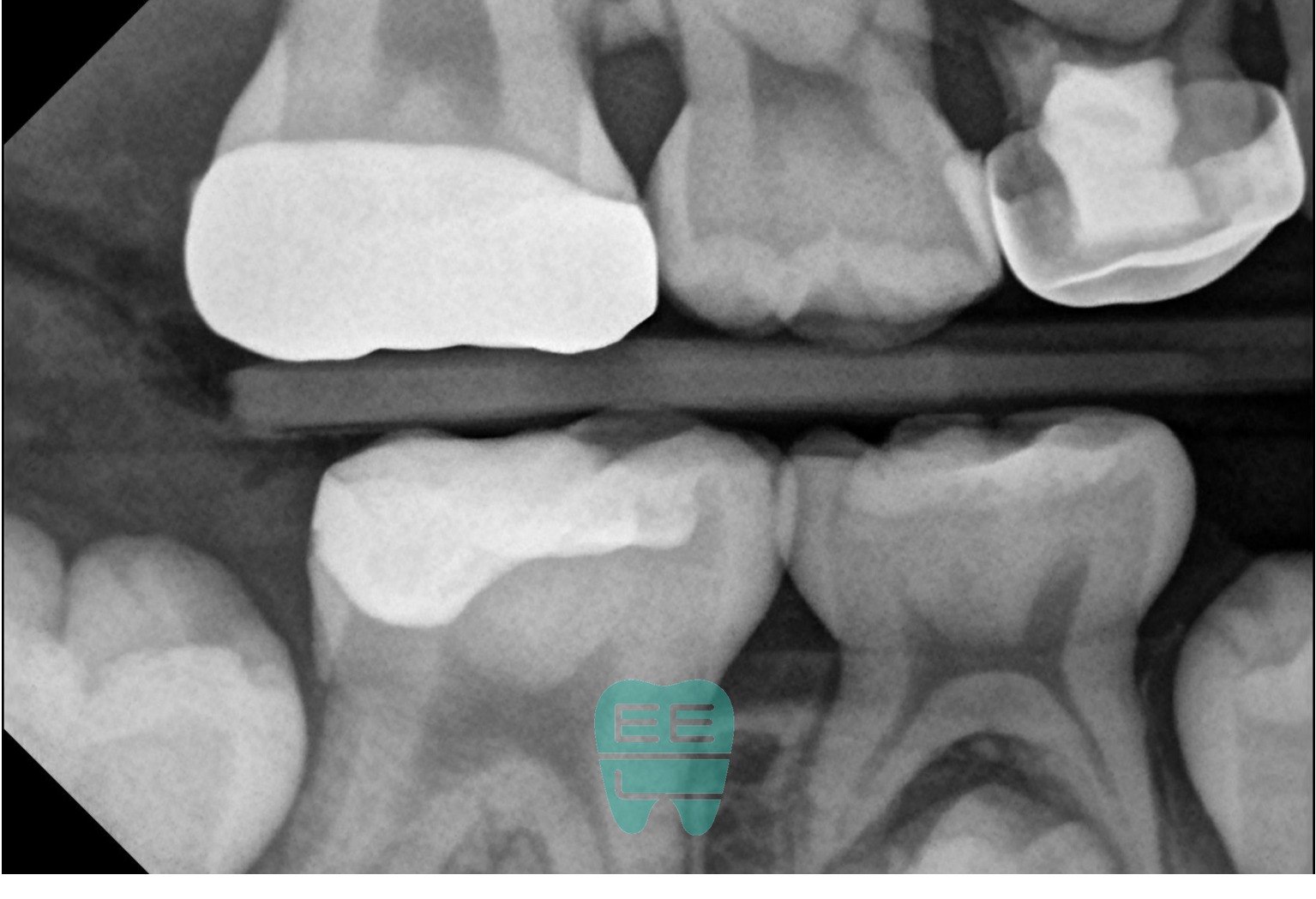 치료 후 교익방사선 사진 - 적절한 형태가 관찰됨