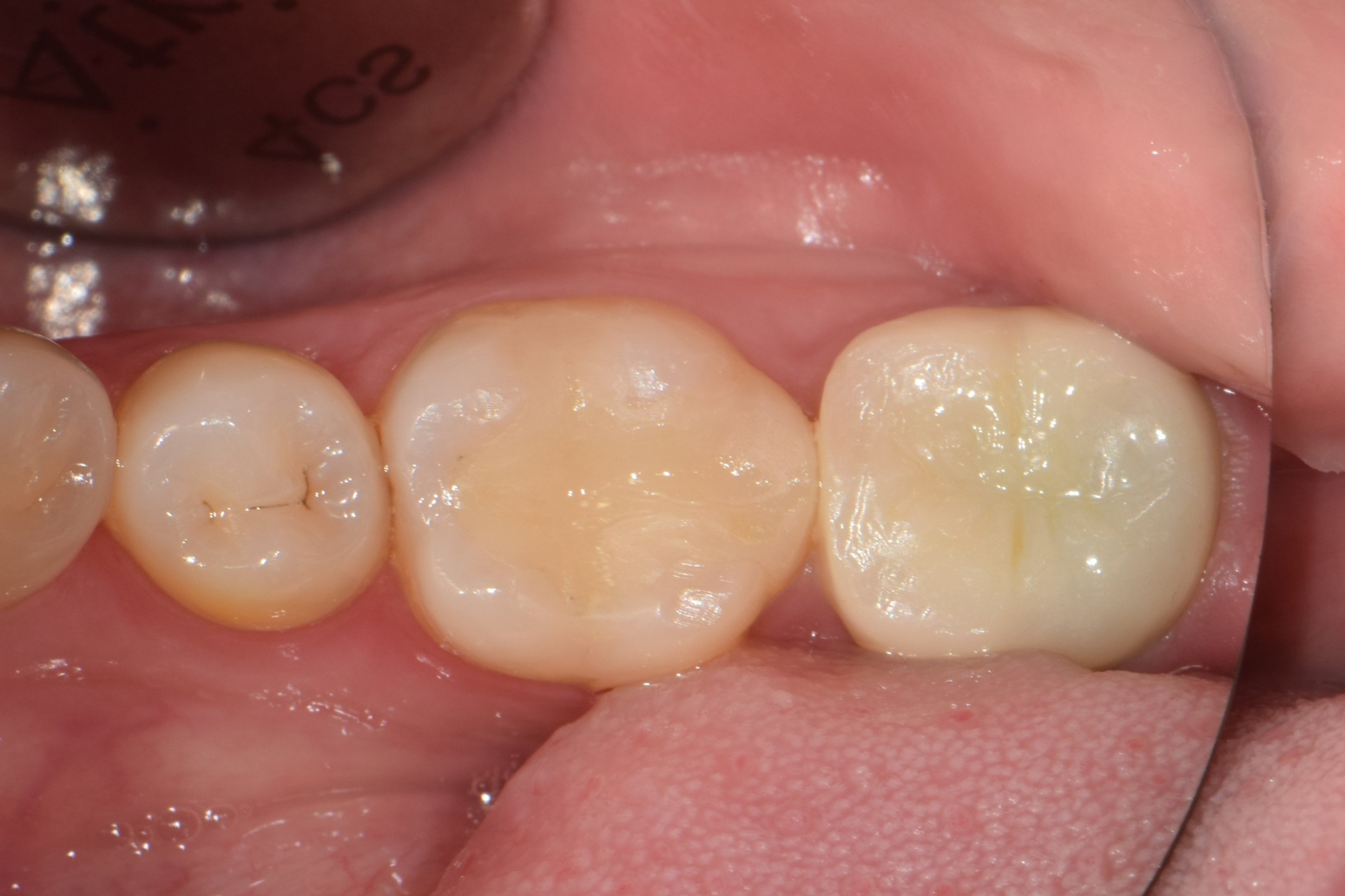 Initial condition — patient reported an unpleasant odor