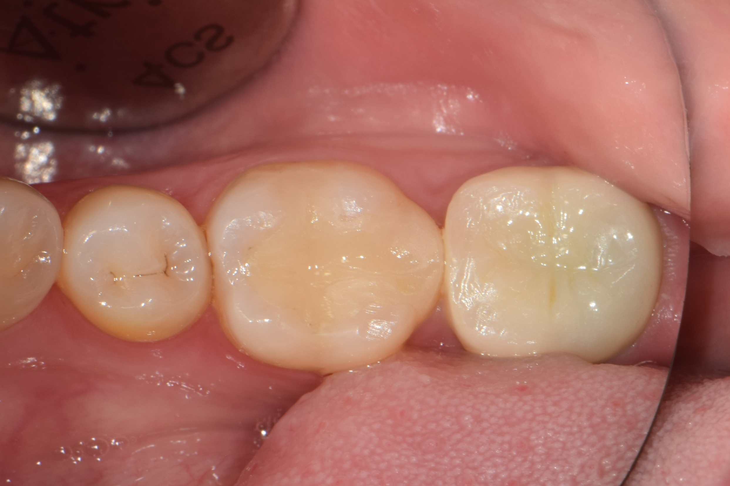 초진상태로 찝찝한 냄새가 나신다 하심