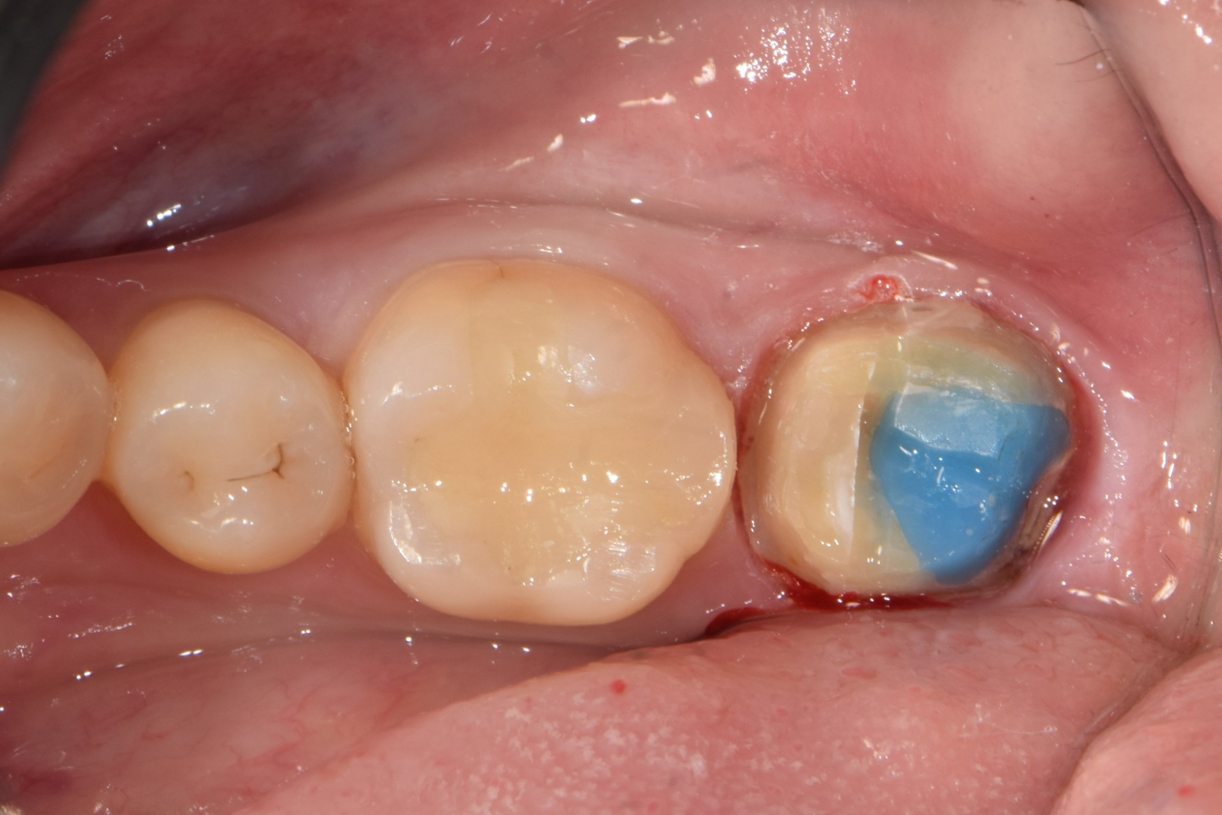 After crown removal — blue core material visible