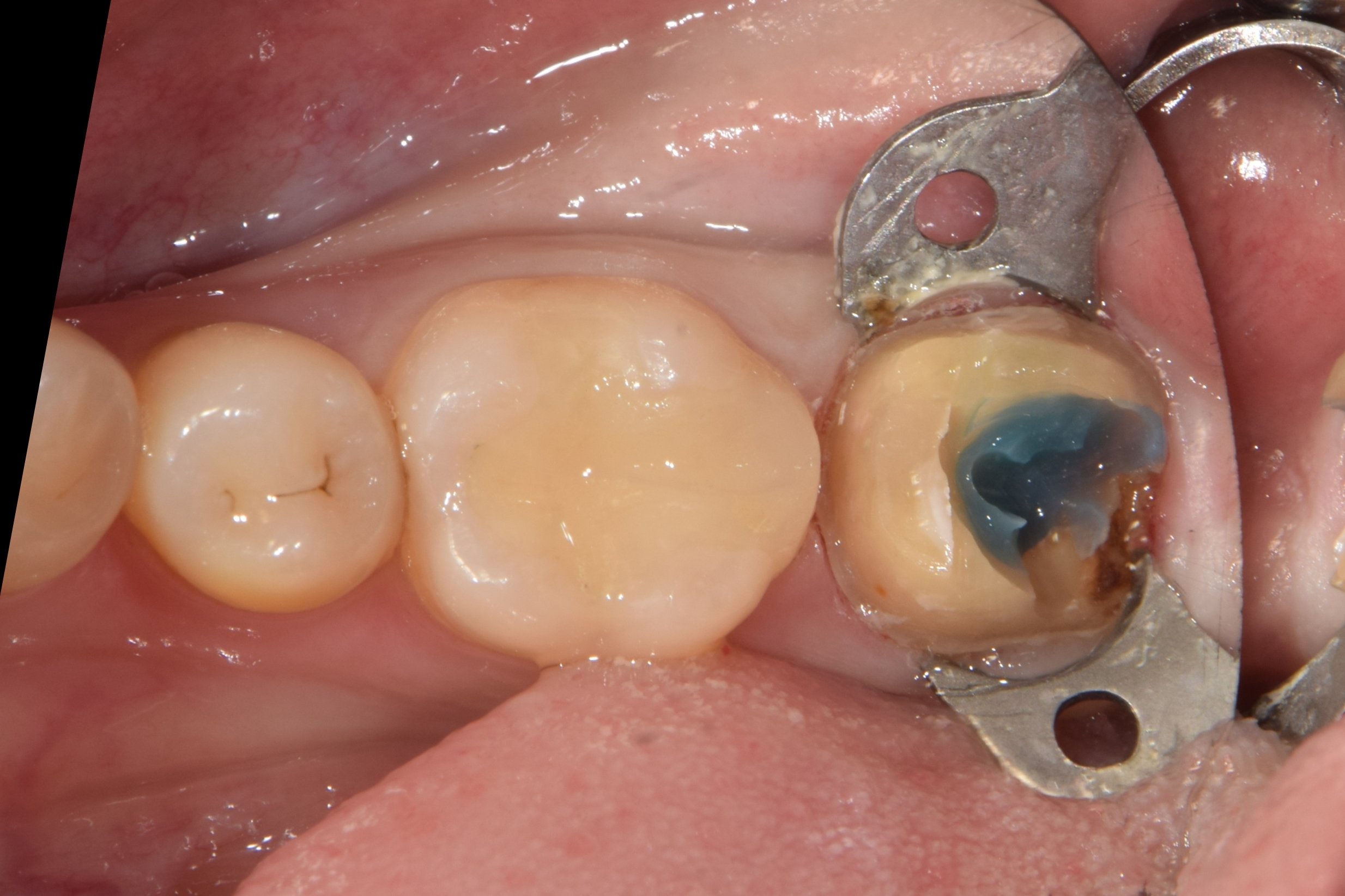 After core removal — diagnosed as foul odor caused by leakage from distal secondary caries