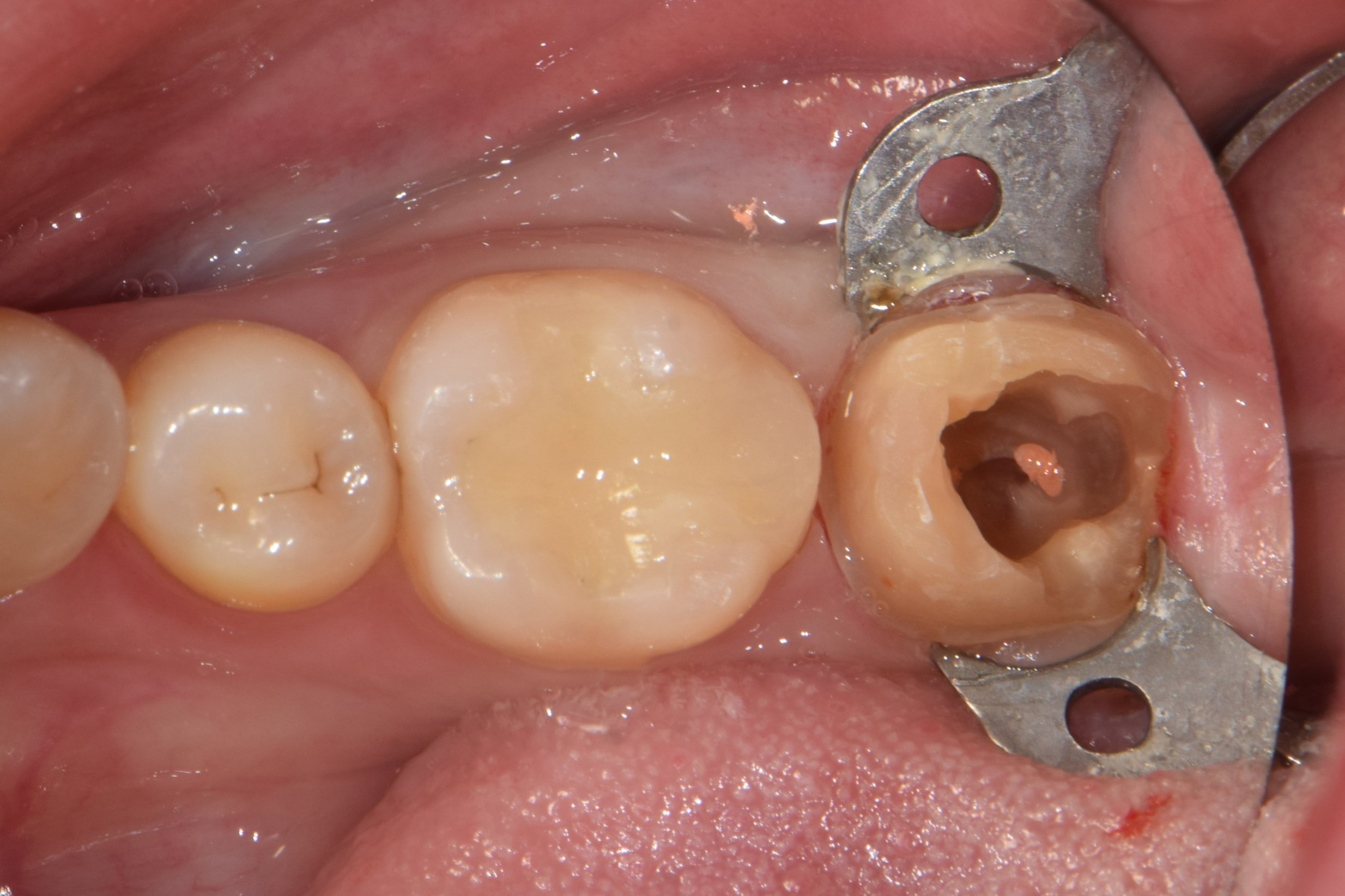 After complete removal of caries and resin core