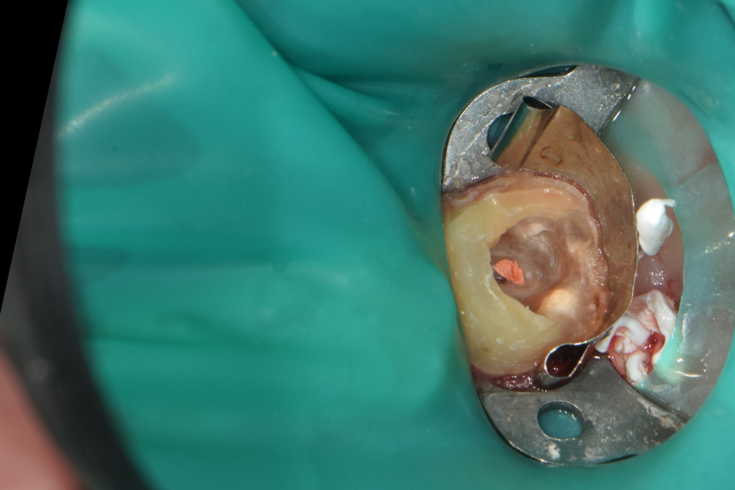 Rubber dam and matrix band placement for distal wall isolation