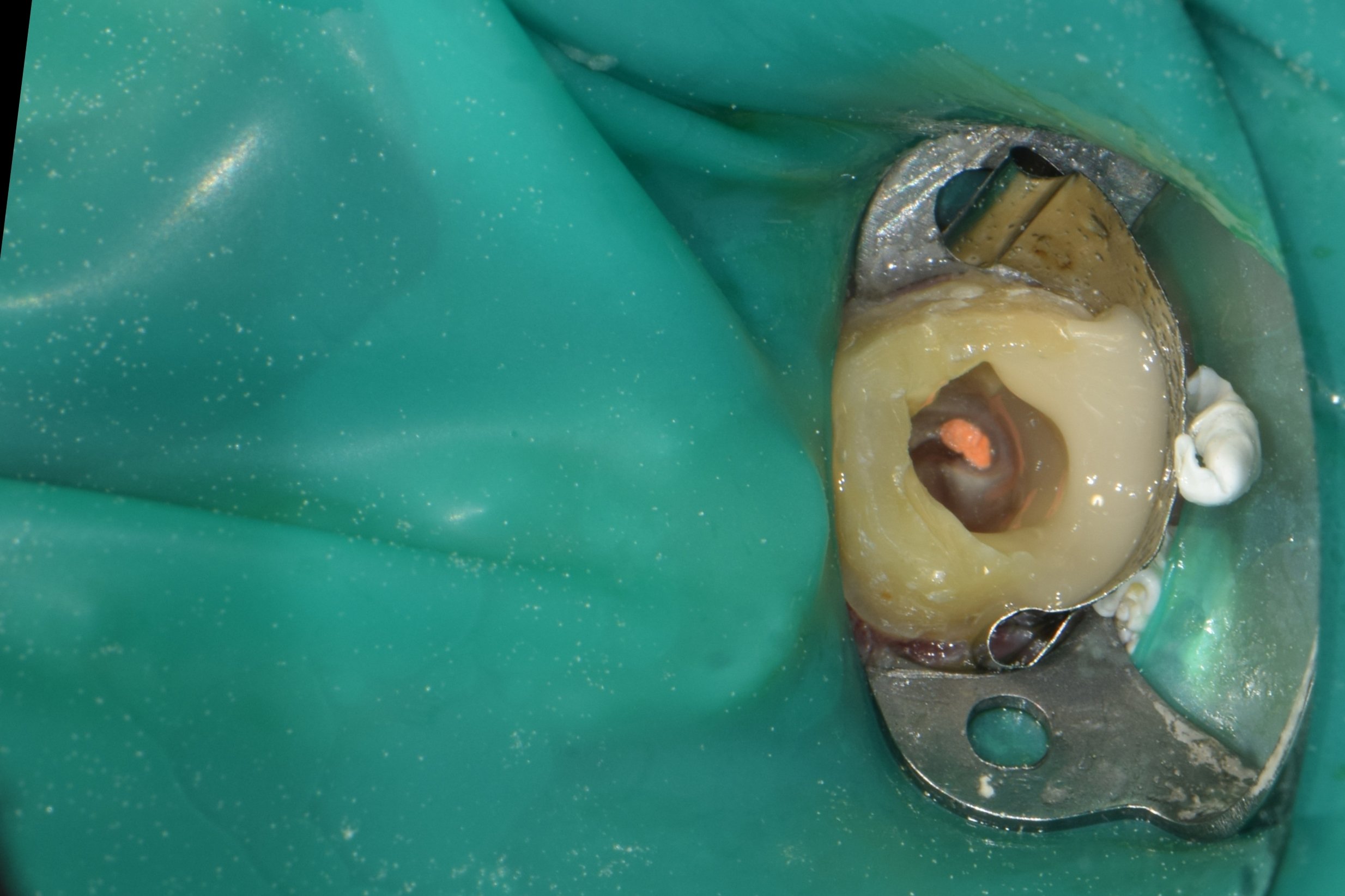 Distal resin wall constructed under rubber dam isolation