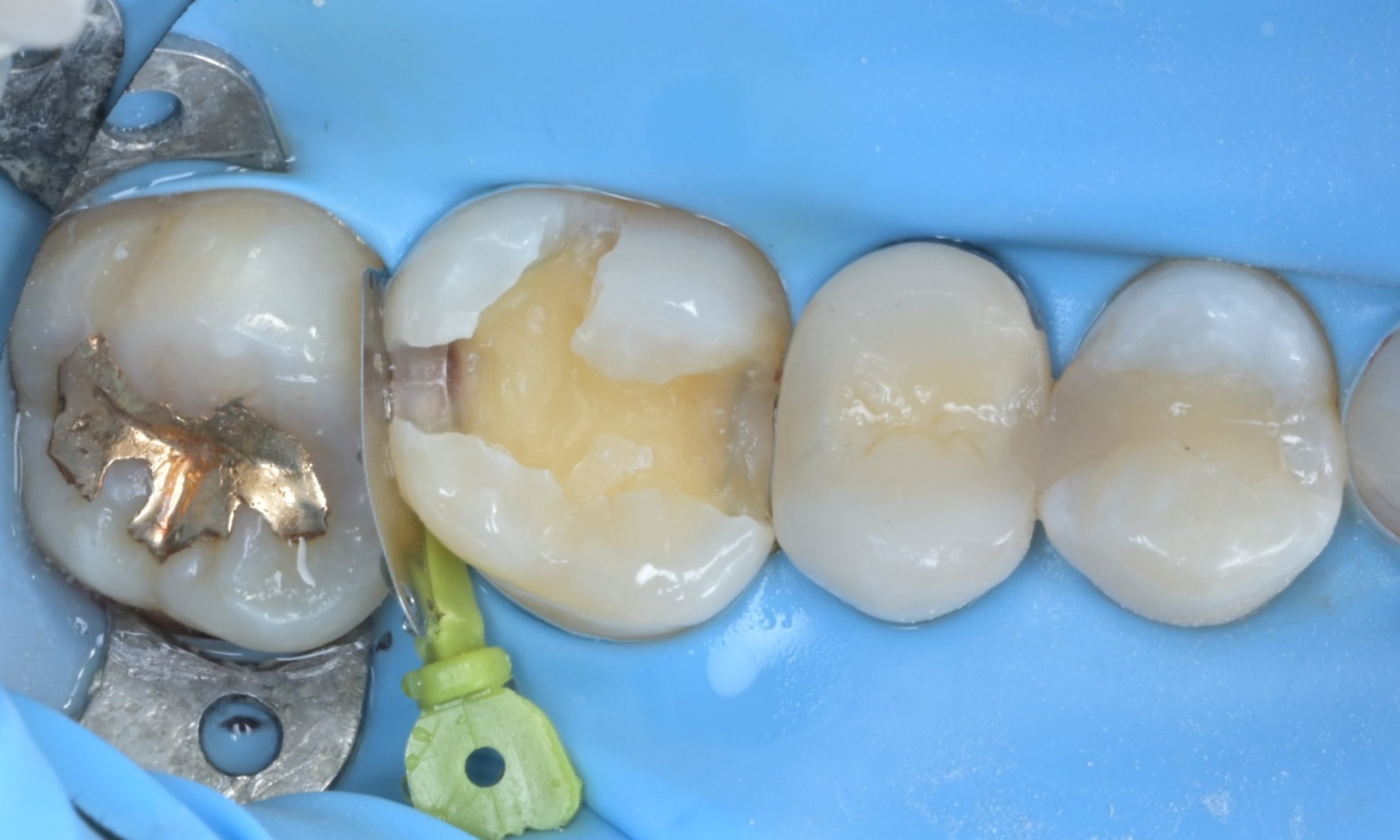 러버댐을 장착하여 충치를 제거중인 모습