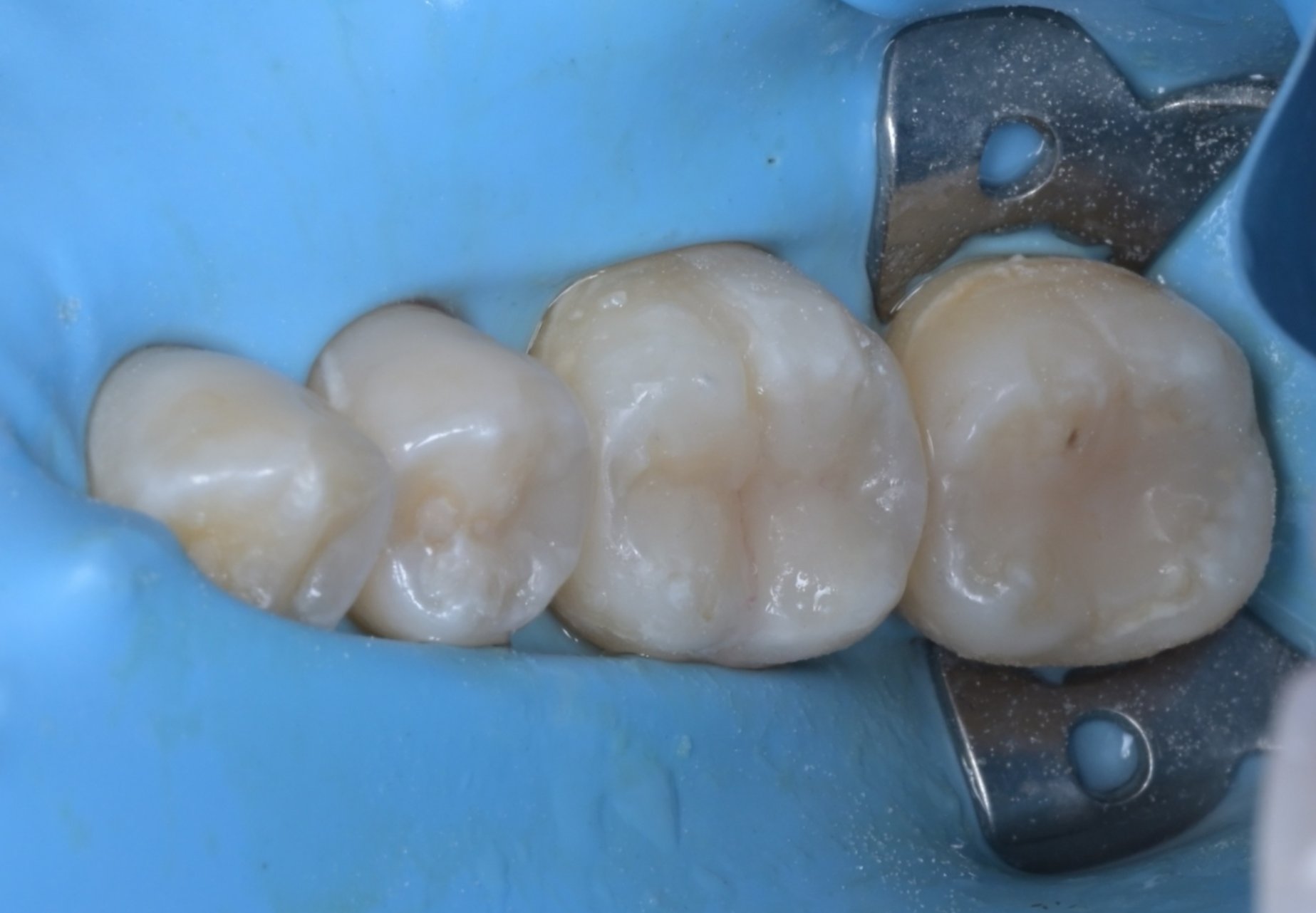 러버댐 하에 레진빌드업을 완료한 모습, 혀나 침의 방해 없이 치료가 가능하다.