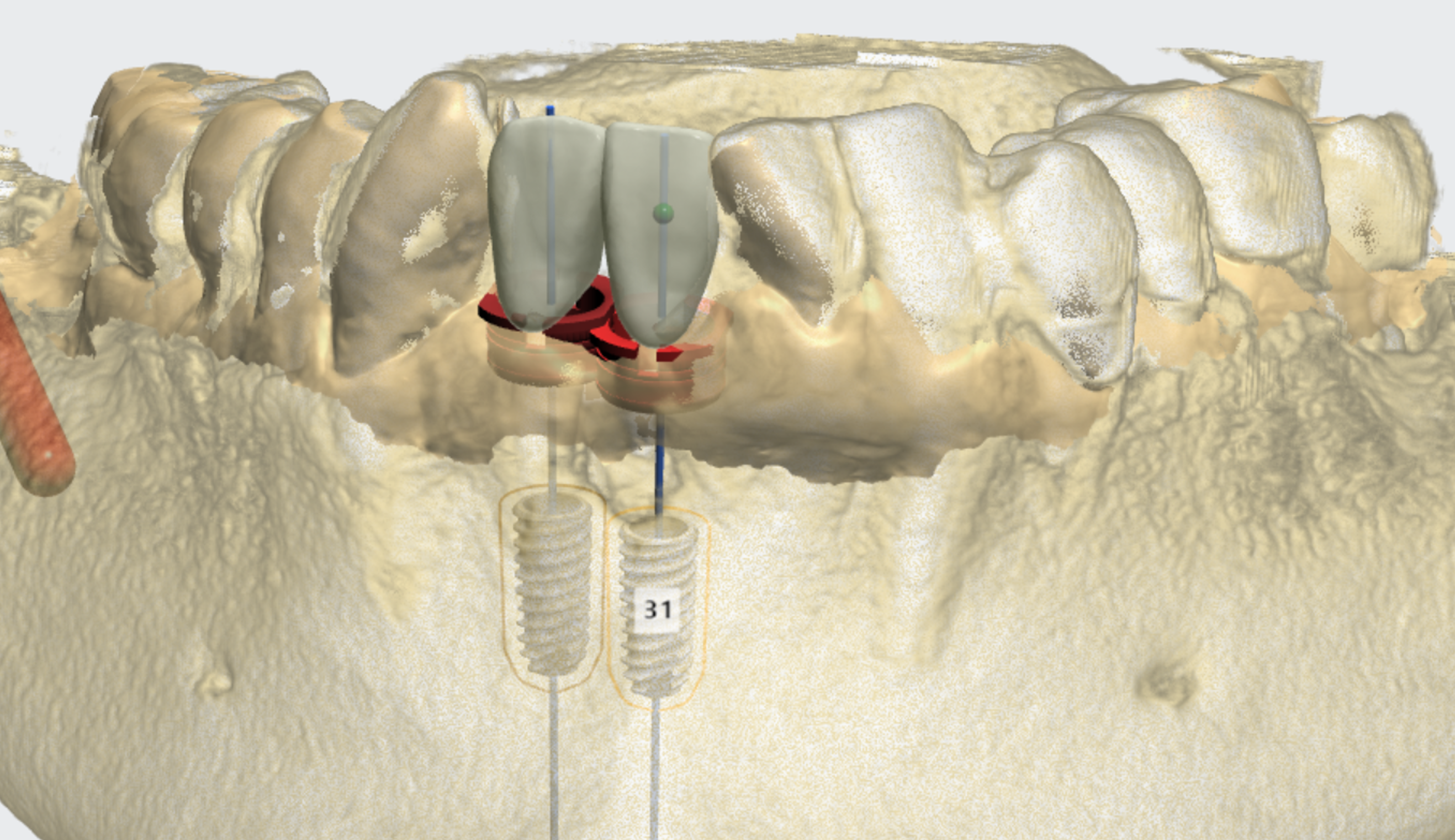 디지털 임플란트